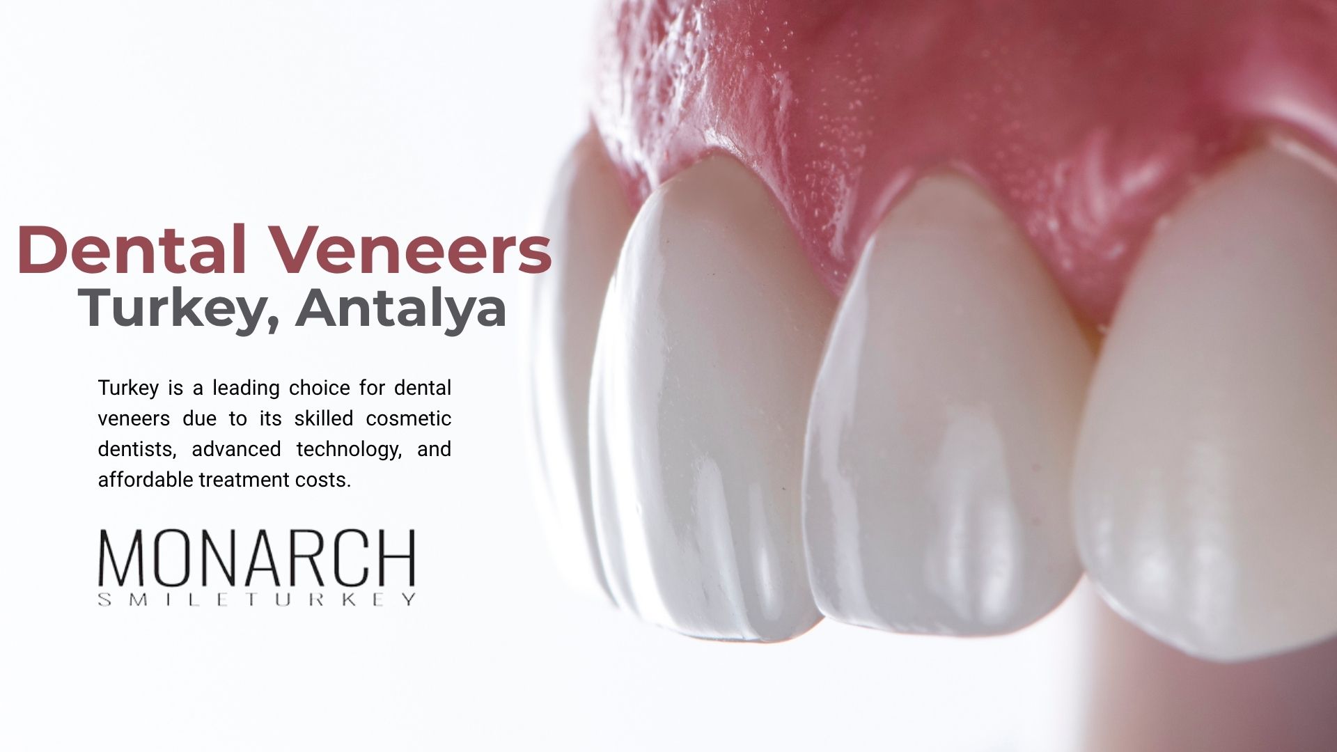Why dental veneers Turkey? Why dental veneers Turkey?