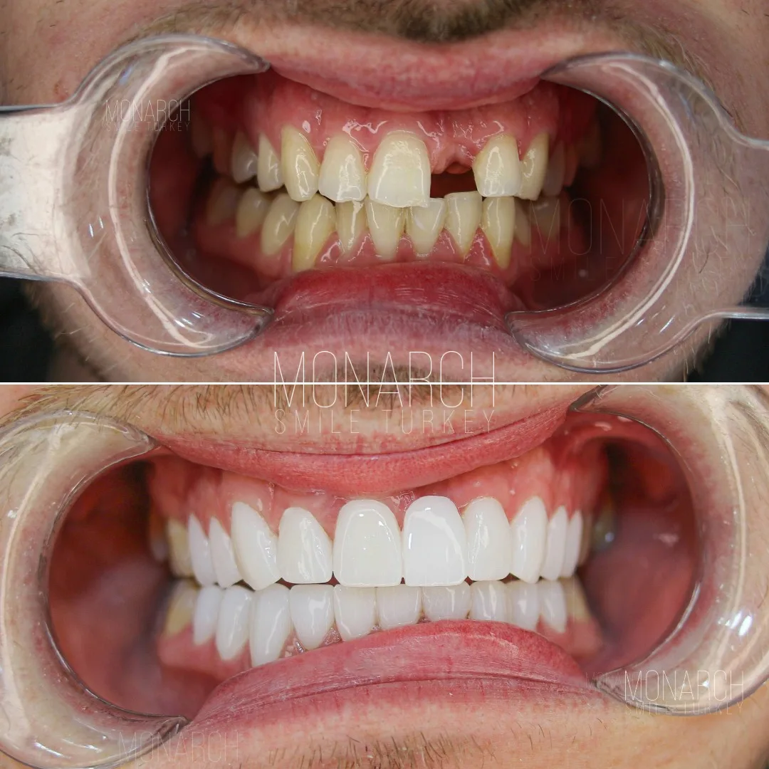  Benefits of implants in Turkey, Antalya 