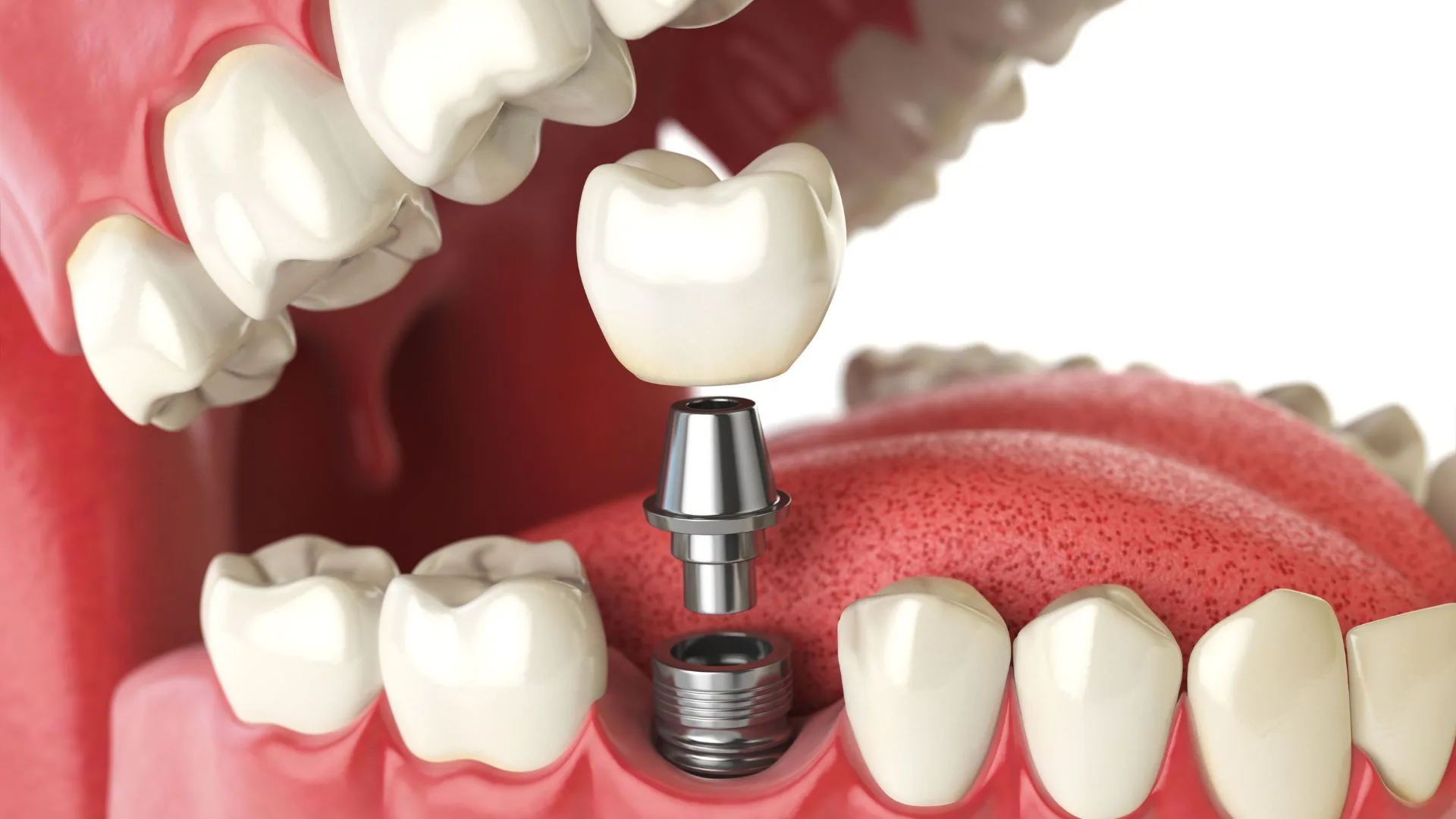  advantages of implants in Turkey, Antalya 