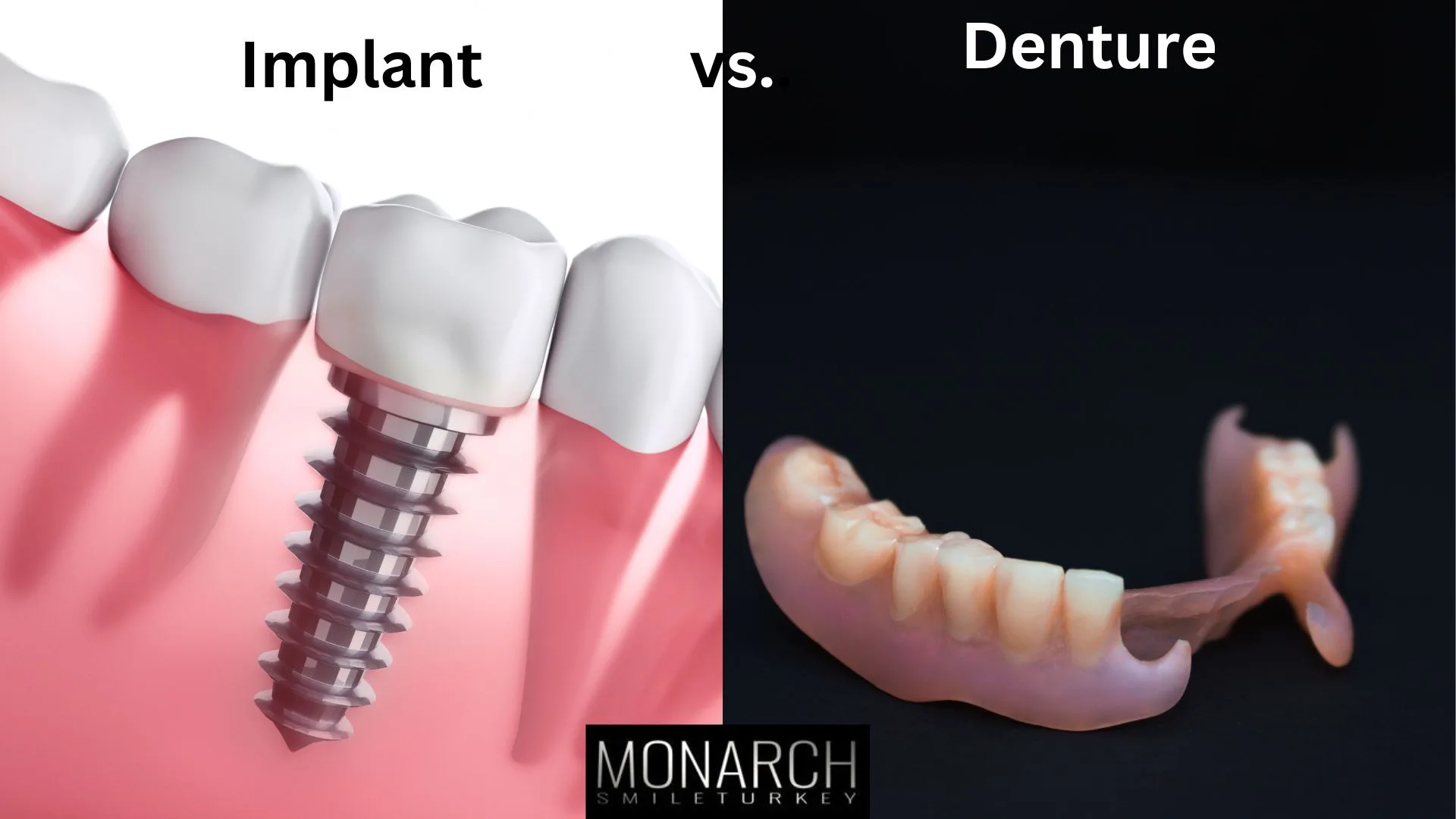 dentures-vs-implants-turkey-antalya