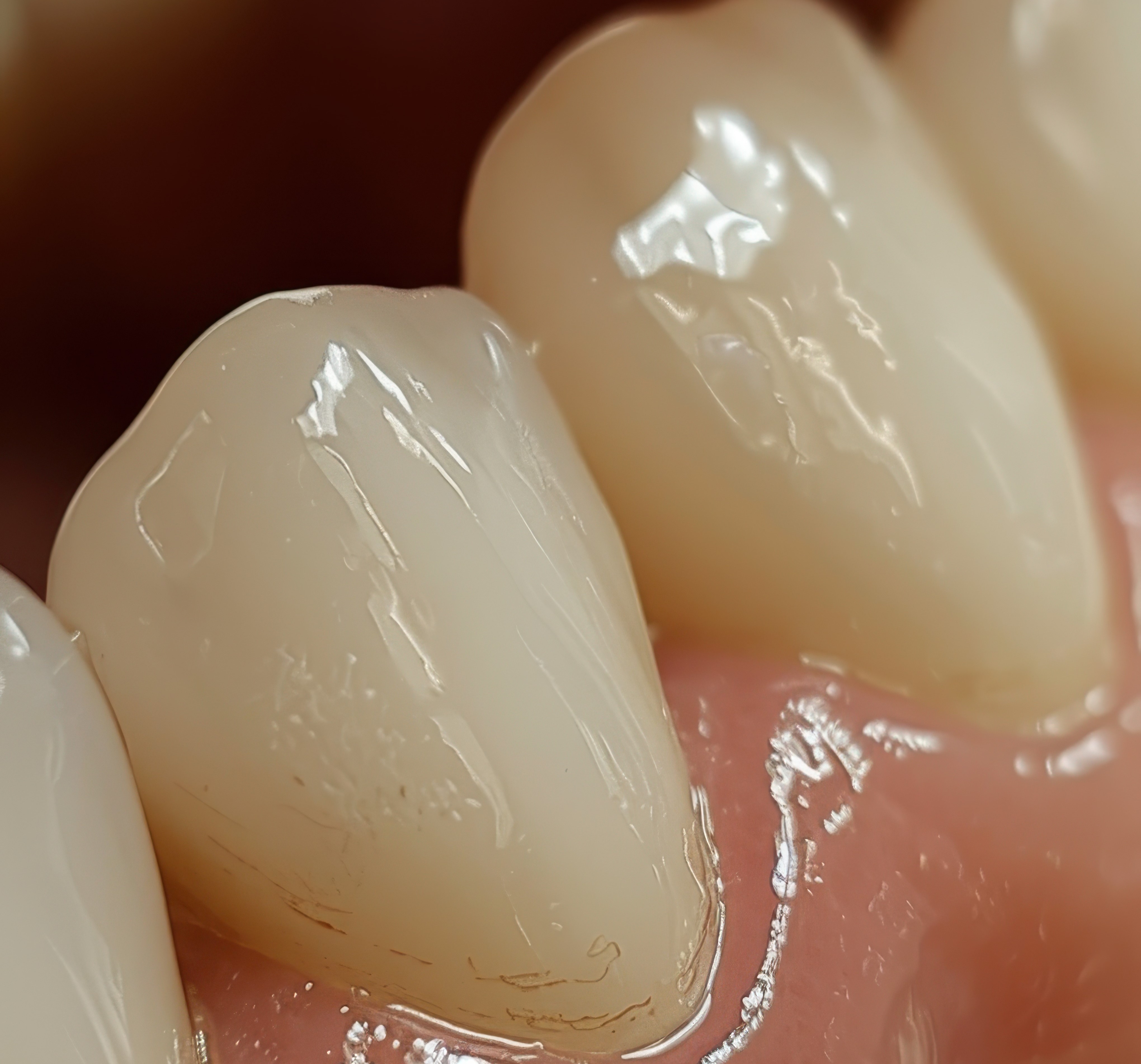  veneers stain
