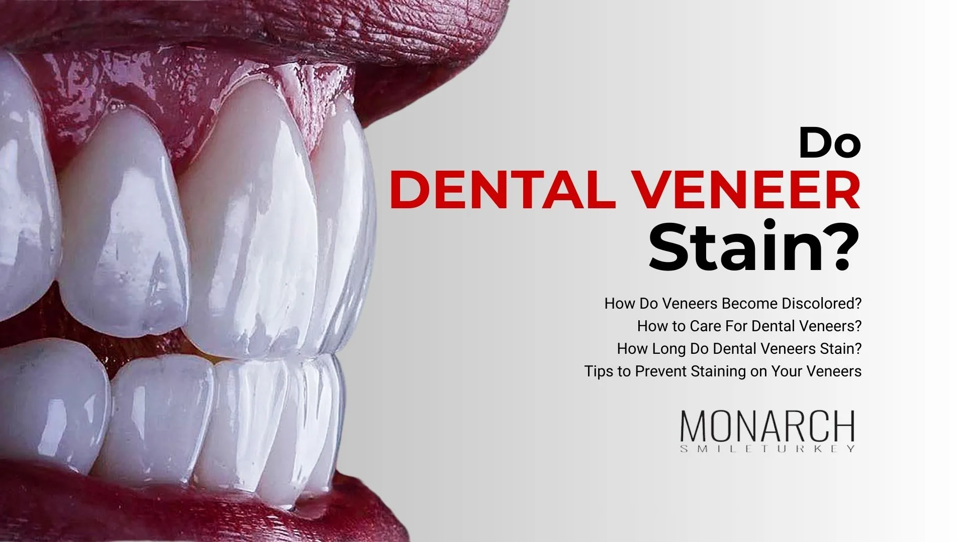 dental-veneers-stain?
