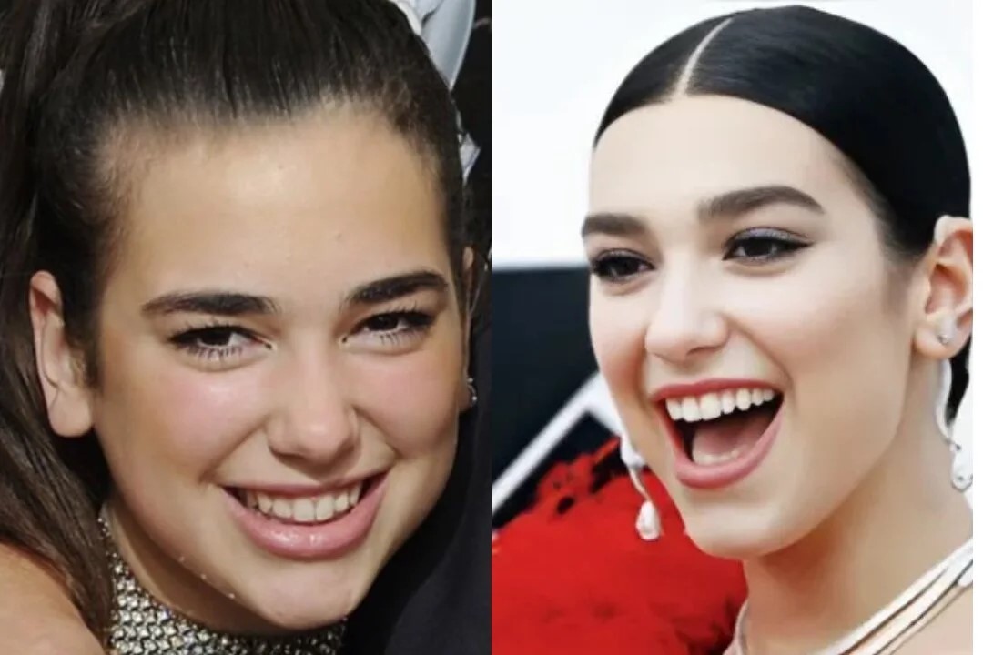 celebrities-with-veneers-Dua Lipa celebrities-with-veneers-Dua Lipa