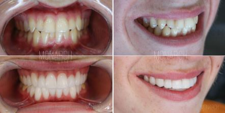 what-are-the-benefits-of-e-max-crowns-veneers-in-turkey