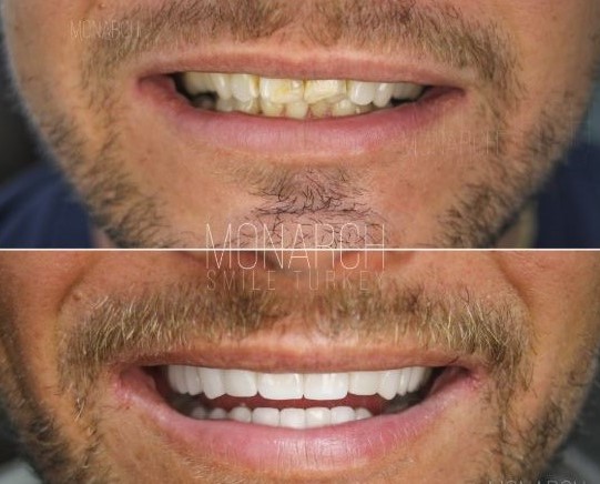 Who are good candidates for Emax and Empress veneers
                                and crowns in Turkey?