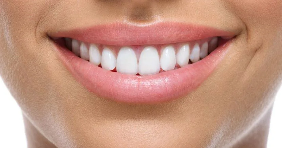 Emax-Empress Crowns and Veneers in Turkey