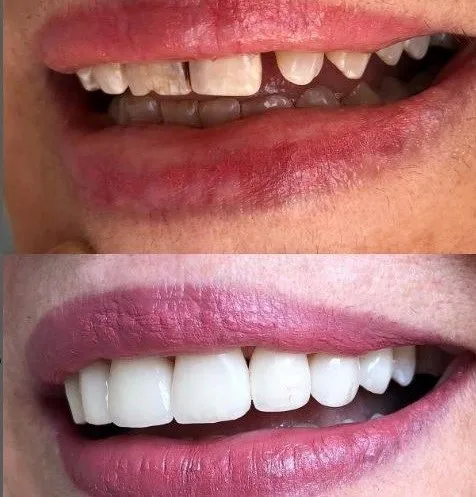 Emax-Empress Veneers Crowns and Veneers in Turkey