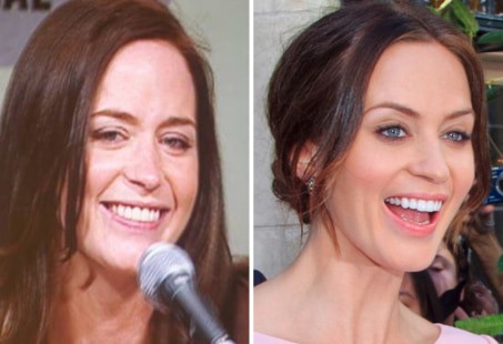 celebrities-with-veneers-Emiliy Blunt celebrities-with-veneers-Emiliy Blunt