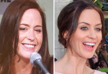 celebrities-with-veneers-Emiliy Blunt celebrities-with-veneers-Emiliy Blunt