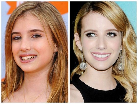 celebrities-with-veneers-Emma Roberts celebrities-with-veneers-Emma Roberts