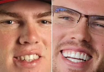 celebrities-with-veneers-Freddie Freeman celebrities-with-veneers-Freddie Freeman