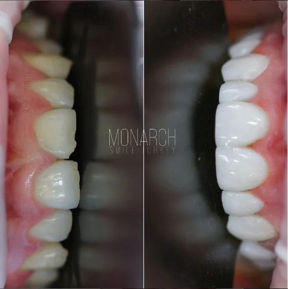 FULL SET Composite Veneers in turkey, antalya