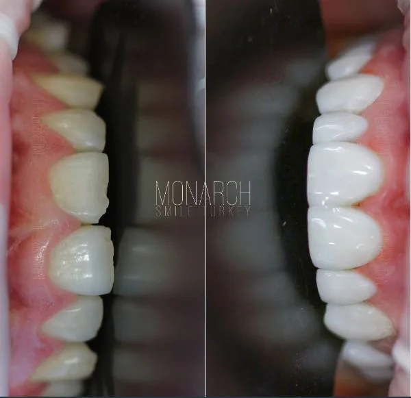 ull-set-composite-bonding-antalya-turkey