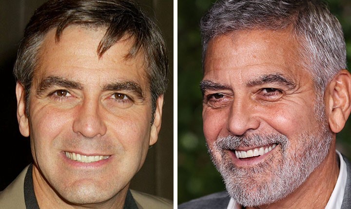 celebrities-with-veneers-george-clooney celebrities-with-veneers-george-clooney