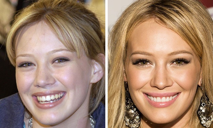 celebrities-with-veneers-Hilary Duff celebrities-with-veneers-Hilary Duff