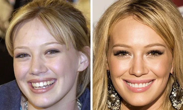 celebrities-with-veneers-Hilary Duff celebrities-with-veneers-Hilary Duff