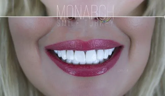 how-is-hollywood-smile-aftercare-turkey-antalya
