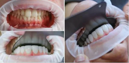 HOLLYWOOD SMILE Composite Bonding İN TURKEY, antalya