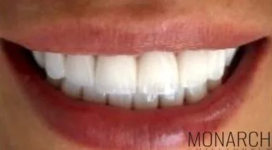 what-is-procedure-for-smile-design-hollywoodsmile-turkey-antalya