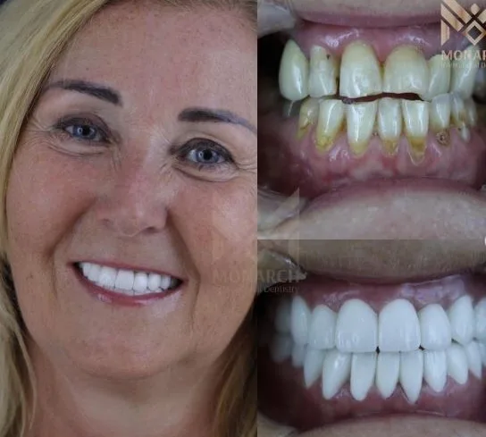 Hollywood smile design with 28 Zirconium Crowns in Turkey, Antalya