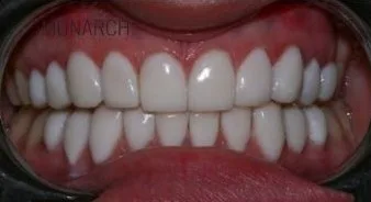 20 set of Hollywood Style Composite Veneers in Turkey, Antalya