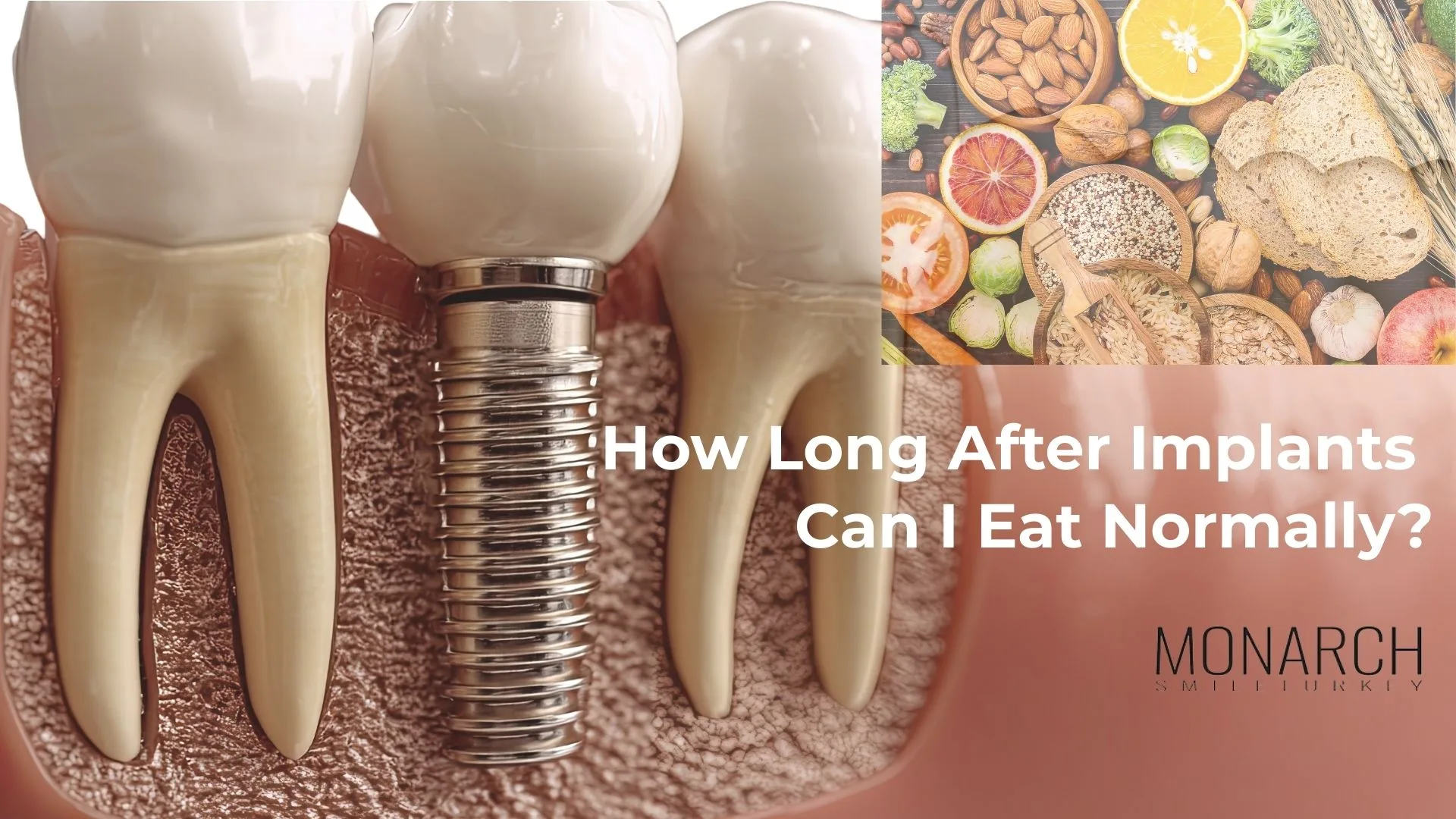 how-long-after-dental-implants-can-i-eat-normally
