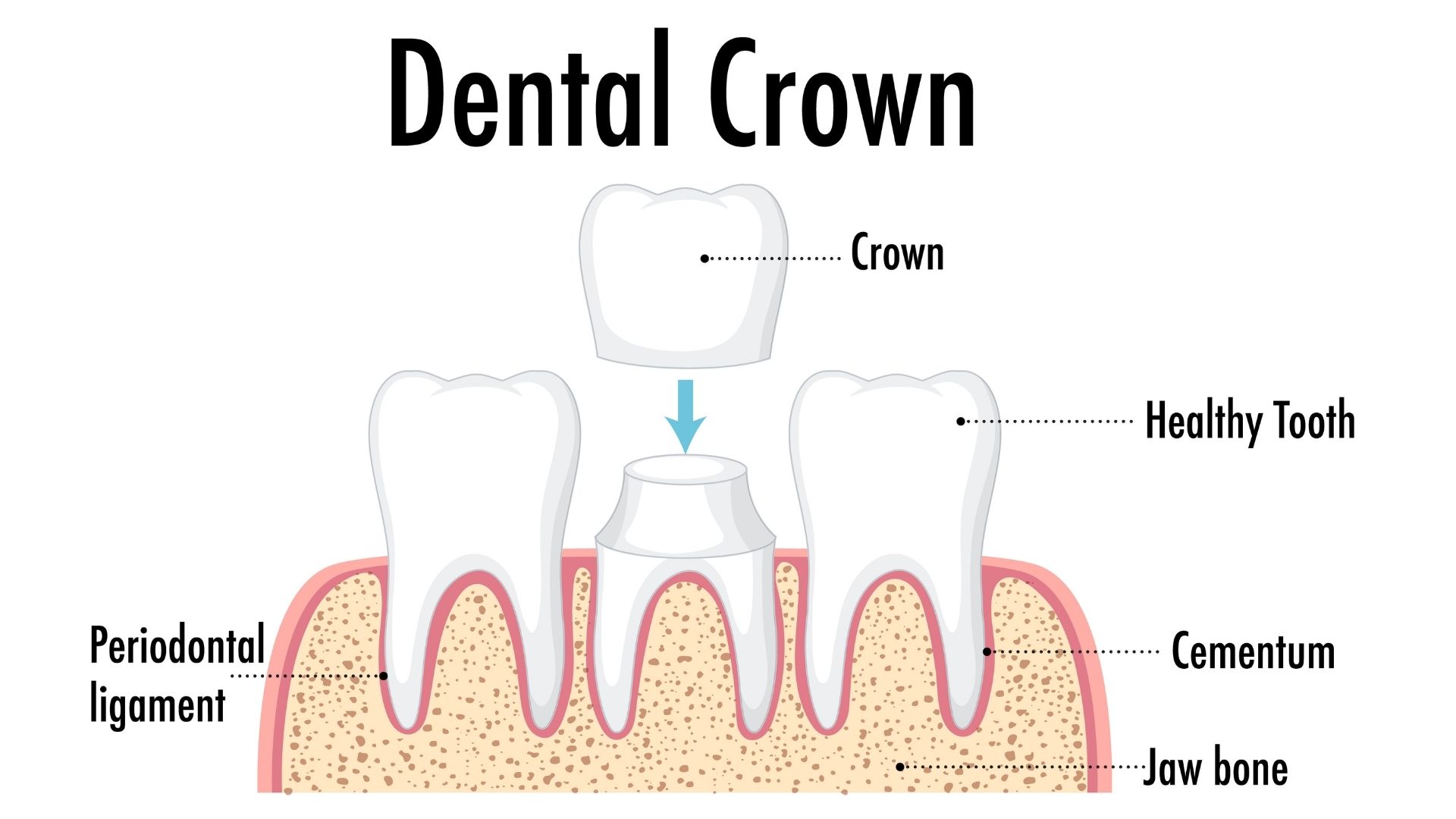What is a Dental Crown?