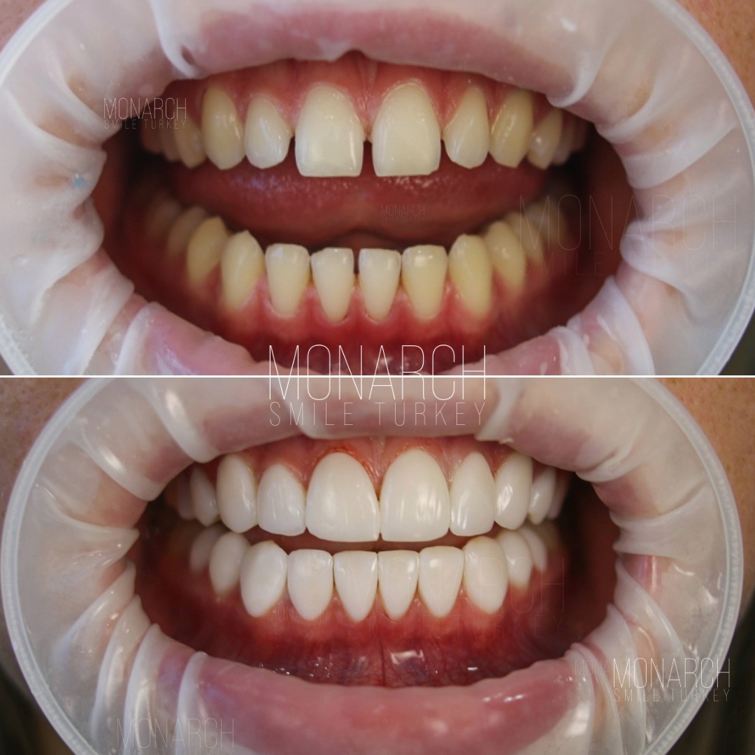 turkey teeth before and after-10