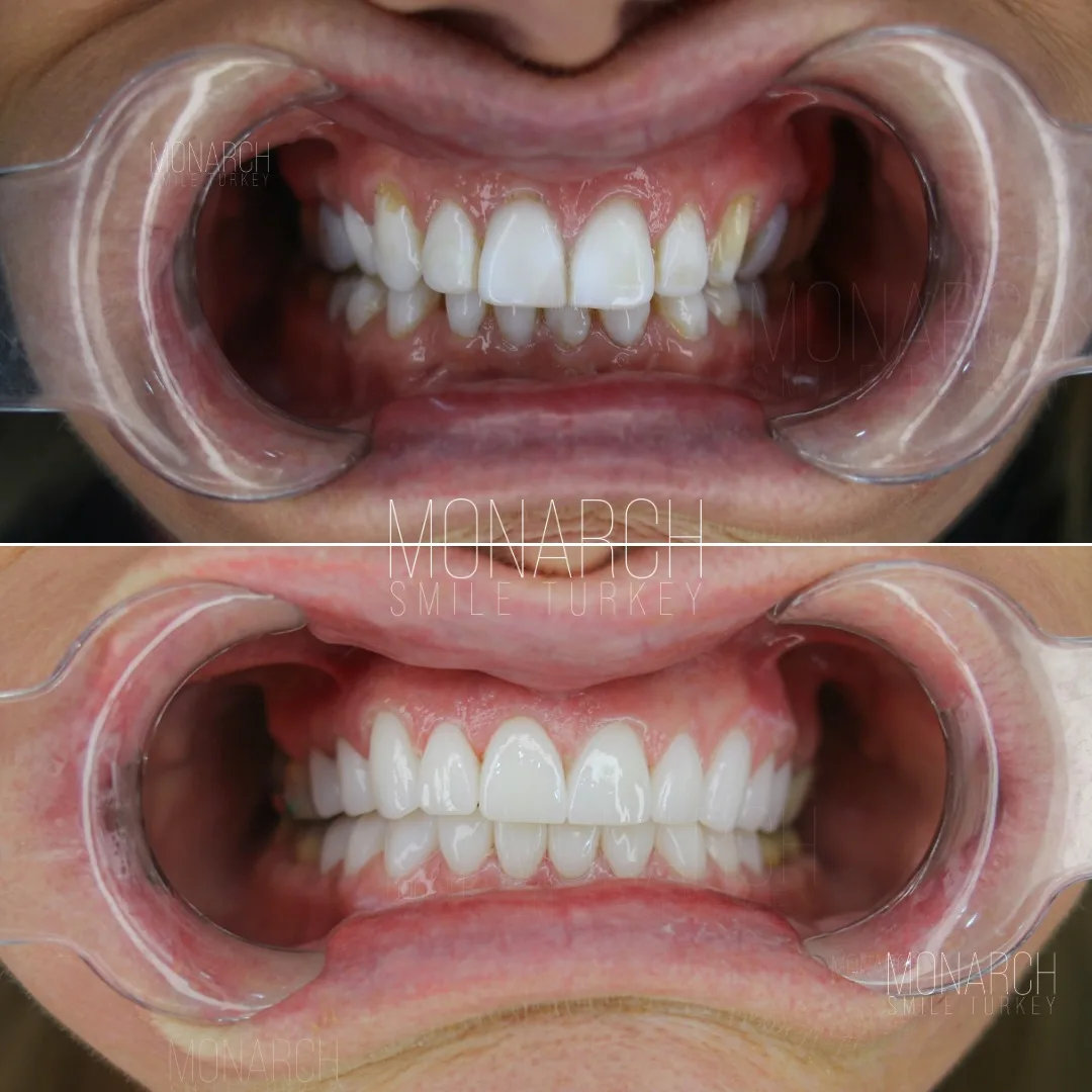 turkey teeth before and after-2