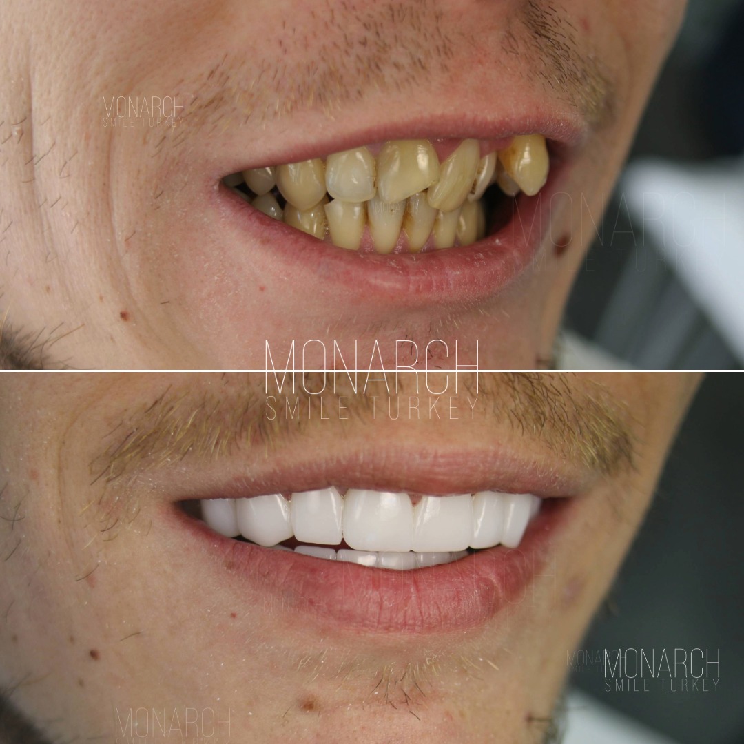 turkey teeth before and after-6