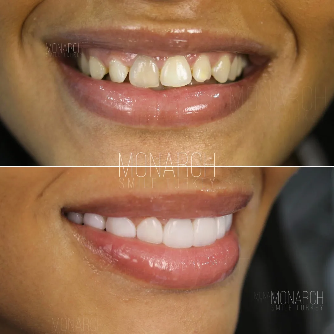 how-long-do-veneers-last-1