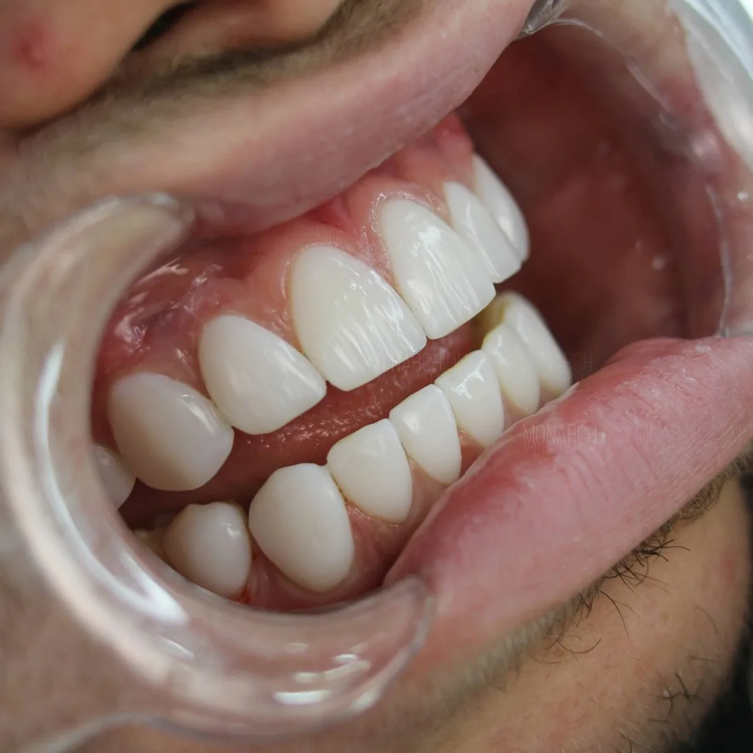 how-long-do-veneers-last-10