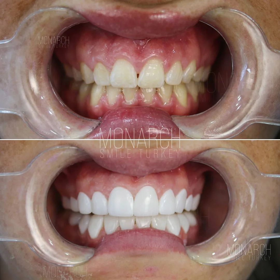 how-long-do-veneers-last-2