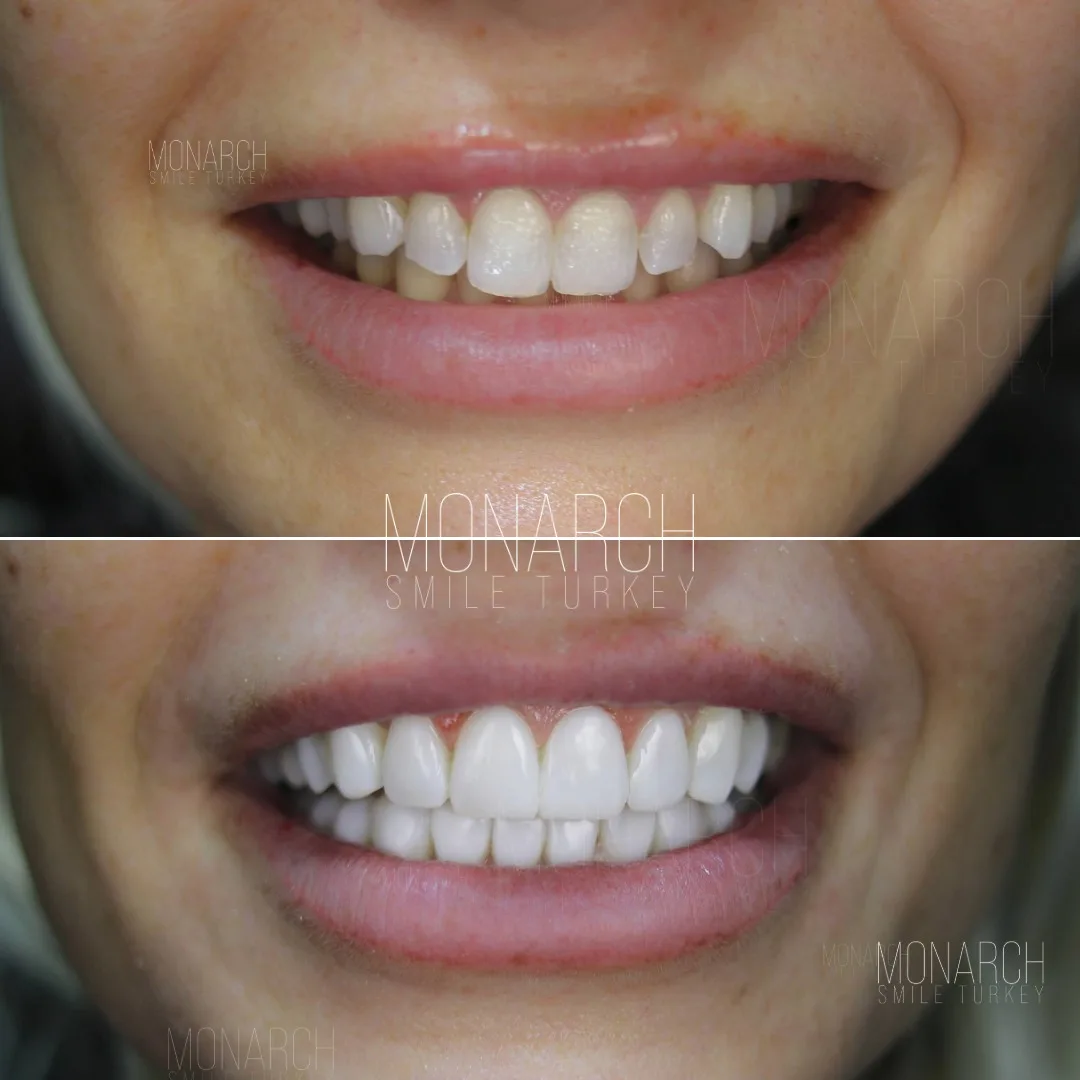 how-long-do-veneers-last-8