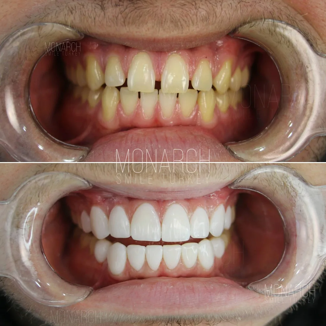how-long-do-veneers-last-9