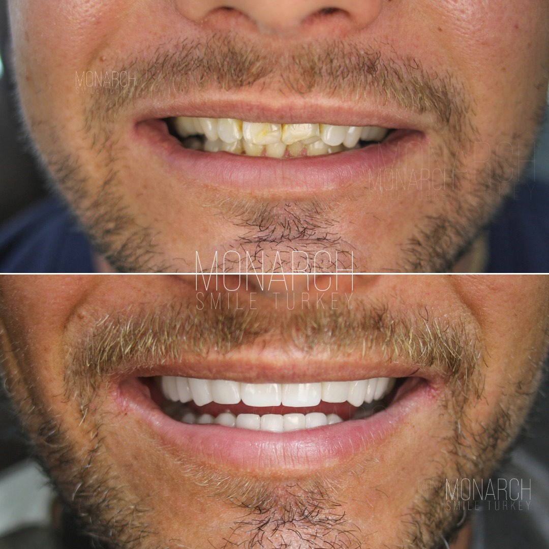 Emax veneers before and after Emax veneers before and after-1