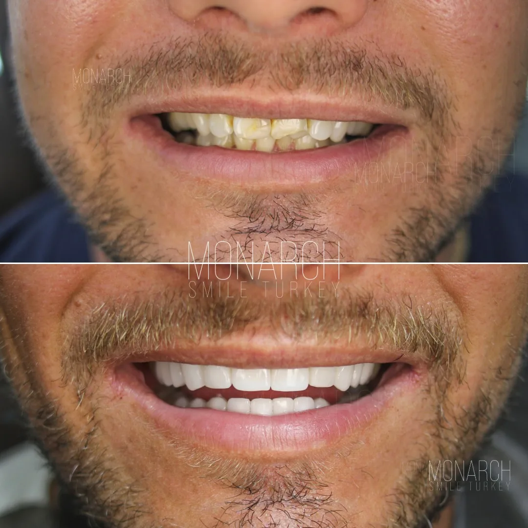 Emax veneers before and after Emax veneers before and after-1