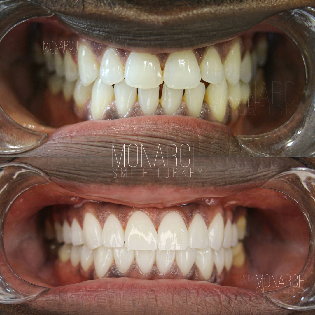 Emax veneers before and after Emax veneers before and after