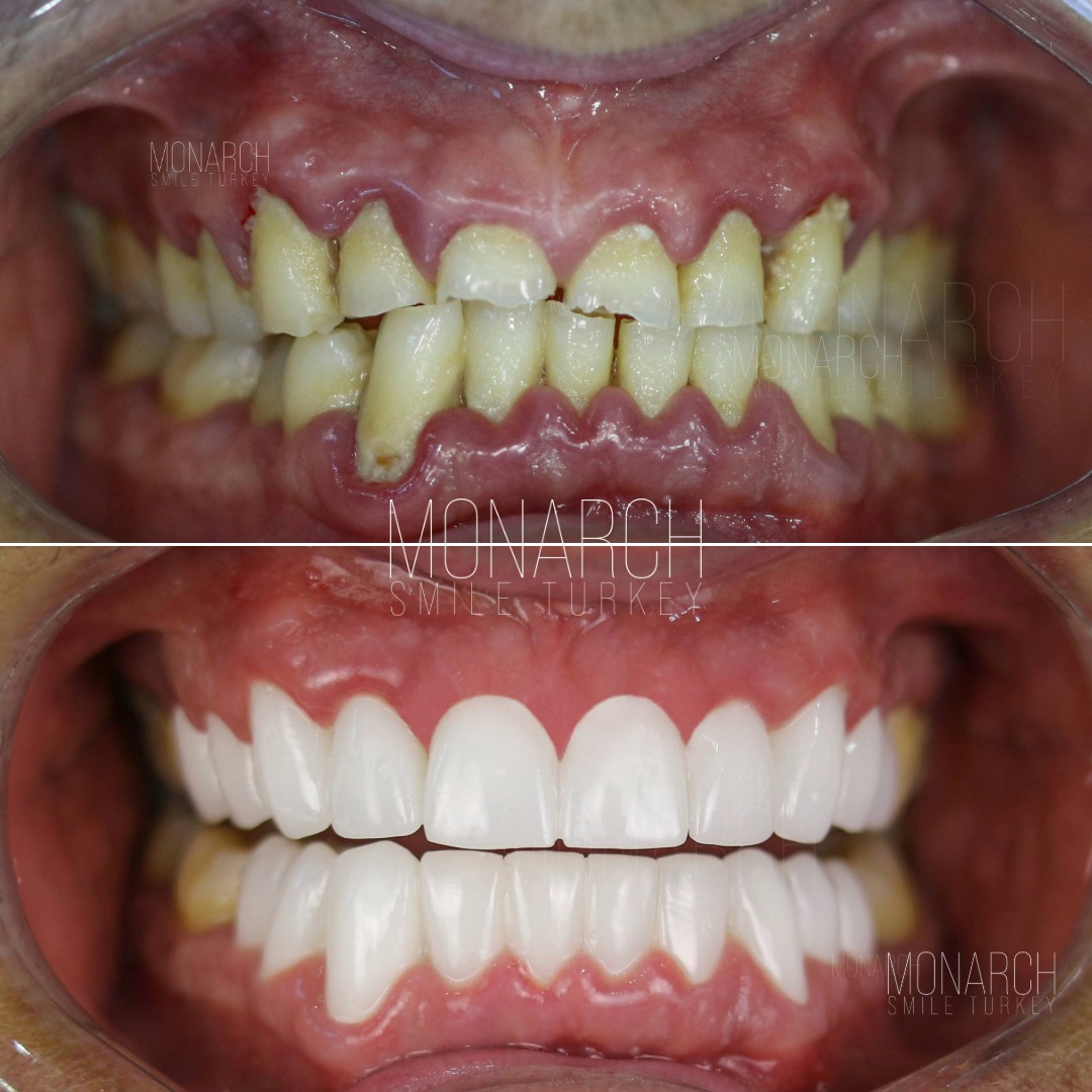 Zirconium veneers before and after-1 Zirconium veneers before and after-1