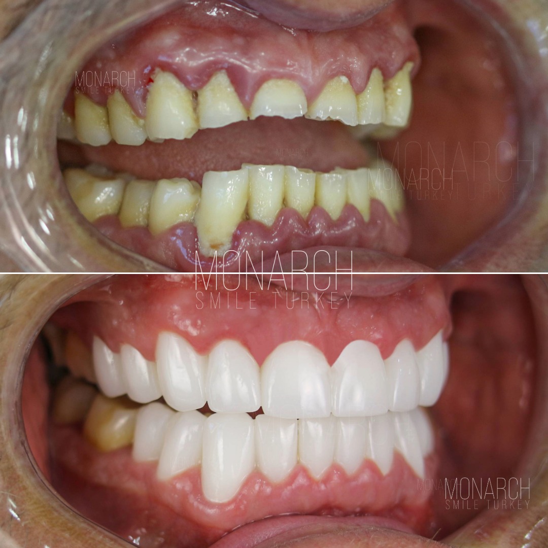 Zirconium veneers before and after-2 Zirconium veneers before and after-2