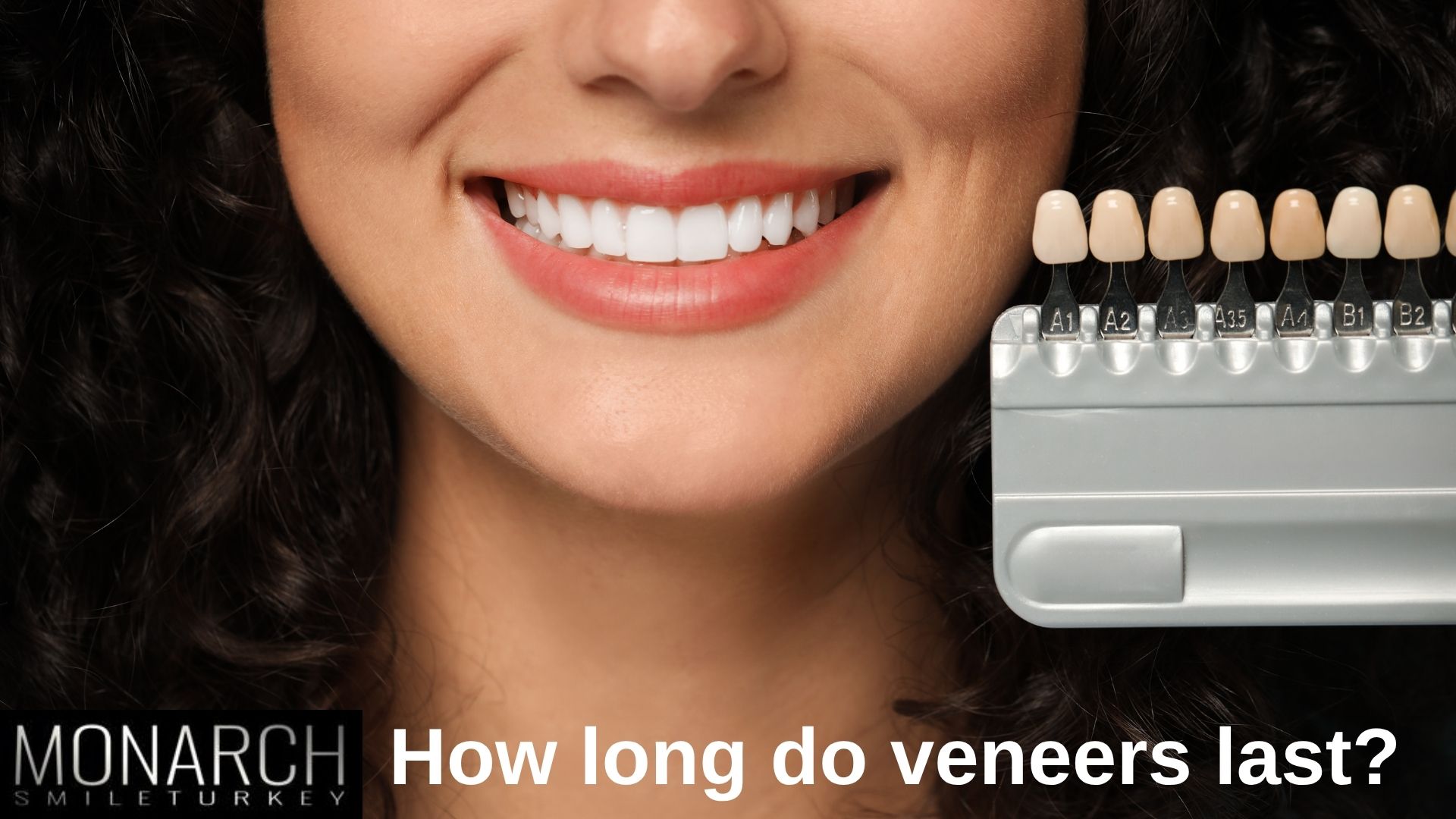 how-long-do-veneers-last