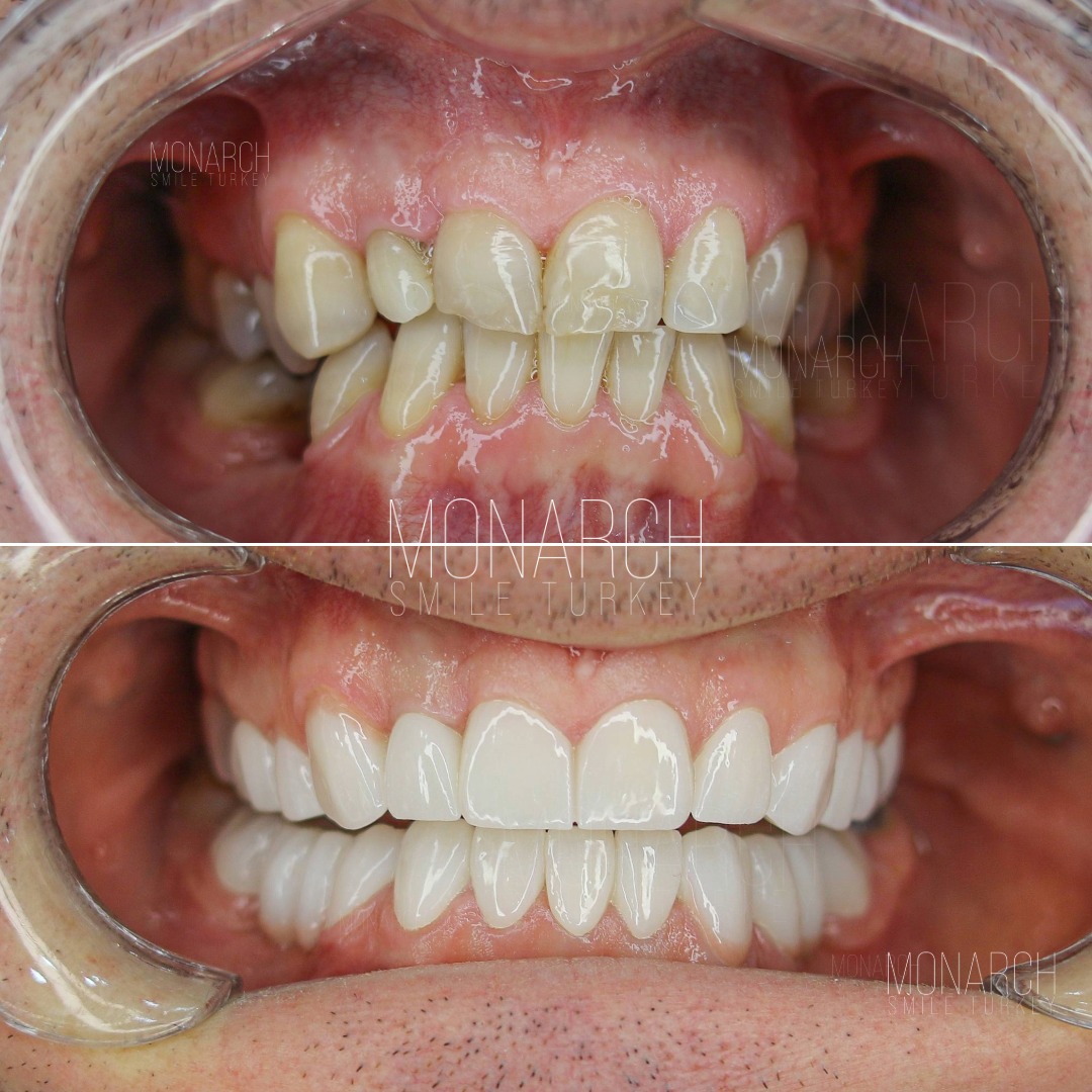 How long do caps on teeth last?