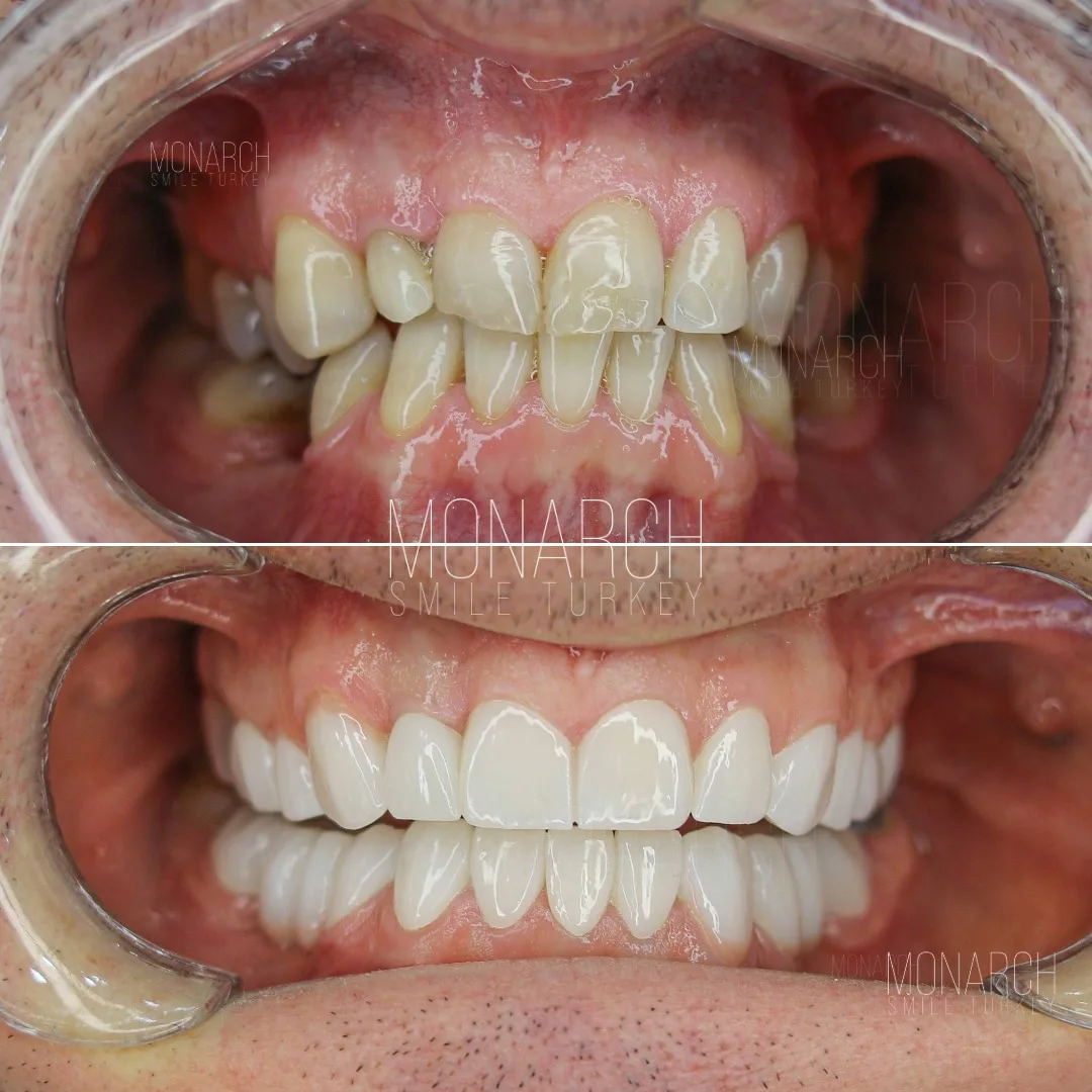 how-long-does-caps-on-teeth-last?
