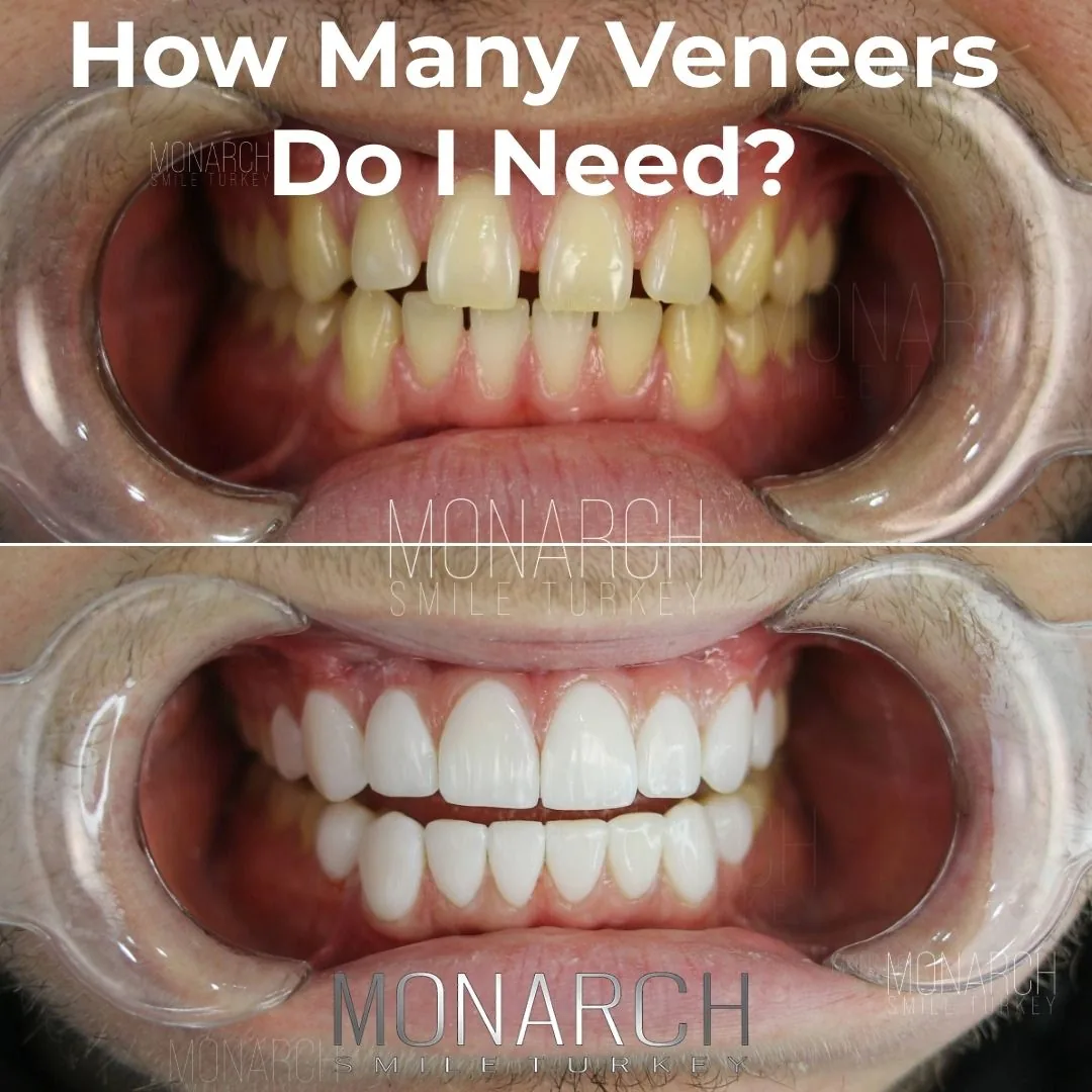How Many Veneers Do I Need? Before and after smile treatment in Antalya, Turkey