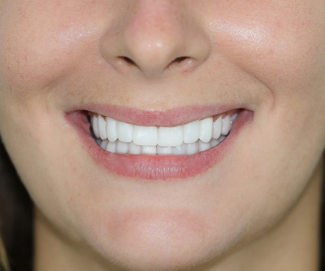  Is it safe to have dental implants in Turkey?