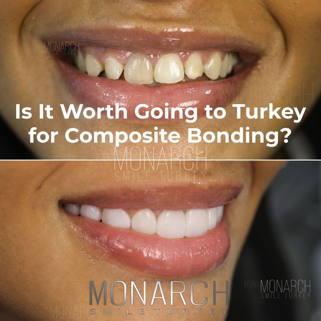 is-it-worth-going-to-turkey-for-composite-bonding?