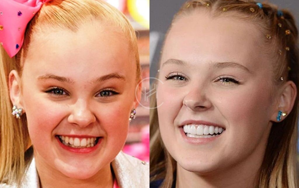 celebrities-with-veneers-Jojo Siwa celebrities-with-veneers-Jojo Siwa