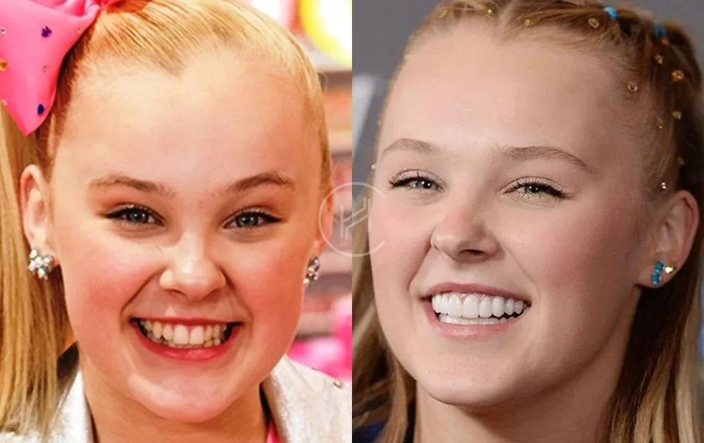 celebrities-with-veneers-Jojo Siwa celebrities-with-veneers-Jojo Siwa