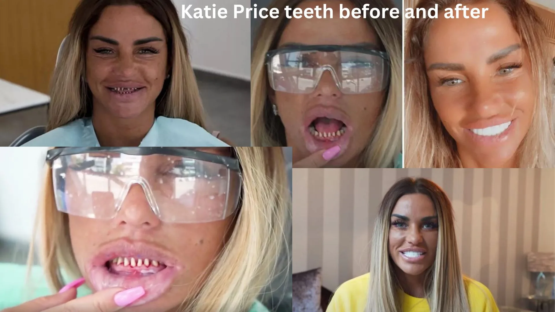 Katie Price teeth before and after veneers Katie Price teeth before and after veneers
