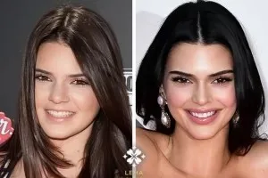 celebrities-with-veneers-Kendall Jenner celebrities-with-veneers-Kendall Jenner